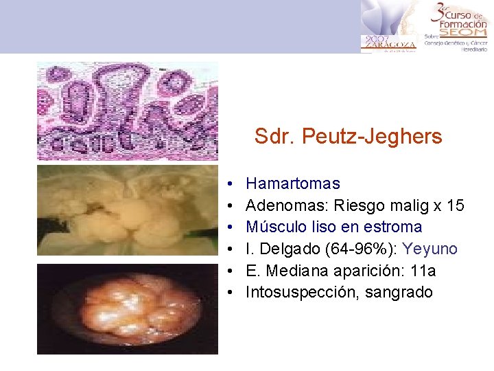 Sdr. Peutz-Jeghers • • • Hamartomas Adenomas: Riesgo malig x 15 Músculo liso en