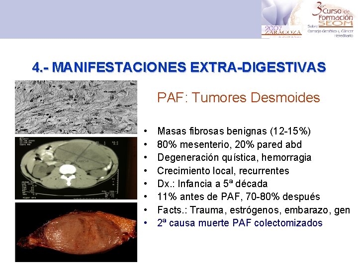 4. - MANIFESTACIONES EXTRA-DIGESTIVAS PAF: Tumores Desmoides • • Masas fibrosas benignas (12 -15%)