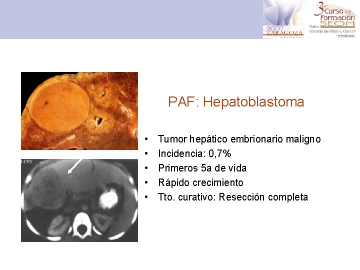 PAF: Hepatoblastoma • • • Tumor hepático embrionario maligno Incidencia: 0, 7% Primeros 5