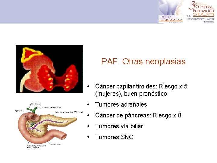 PAF: Otras neoplasias • Cáncer papilar tiroides: Riesgo x 5 (mujeres), buen pronóstico •