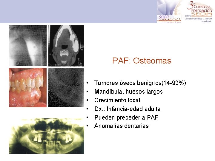 PAF: Osteomas • • • Tumores óseos benignos(14 -93%) Mandíbula, huesos largos Crecimiento local