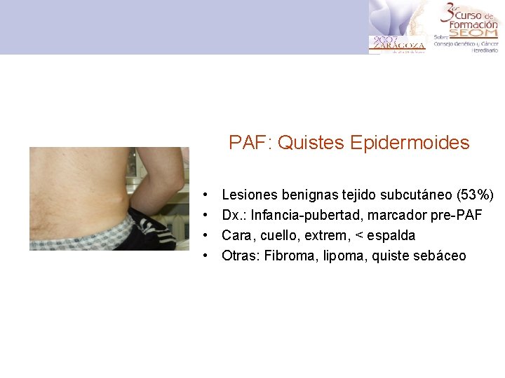 PAF: Quistes Epidermoides • • Lesiones benignas tejido subcutáneo (53%) Dx. : Infancia-pubertad, marcador