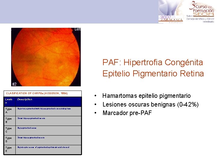 PAF: Hipertrofia Congénita Epitelio Pigmentario Retina CLASIFICATION OF CHRPEs (HODGSON, 1994) Lesio n Description