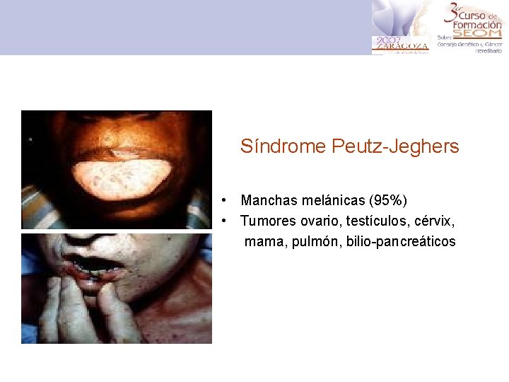 Síndrome Peutz-Jeghers • Manchas melánicas (95%) • Tumores ovario, testículos, cérvix, mama, pulmón, bilio-pancreáticos