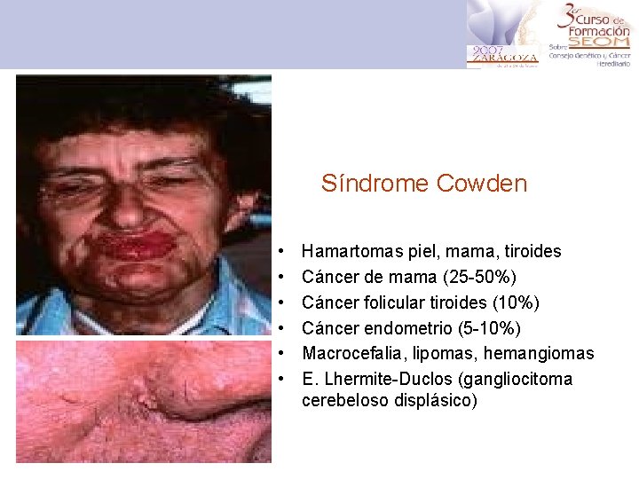 Síndrome Cowden • • • Hamartomas piel, mama, tiroides Cáncer de mama (25 -50%)