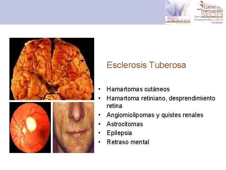 Esclerosis Tuberosa • Hamartomas cutáneos • Hamartoma retiniano, desprendimiento retina • Angiomiolipomas y quistes