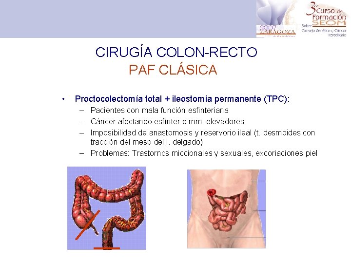 CIRUGÍA COLON-RECTO PAF CLÁSICA • Proctocolectomía total + ileostomía permanente (TPC): – Pacientes con