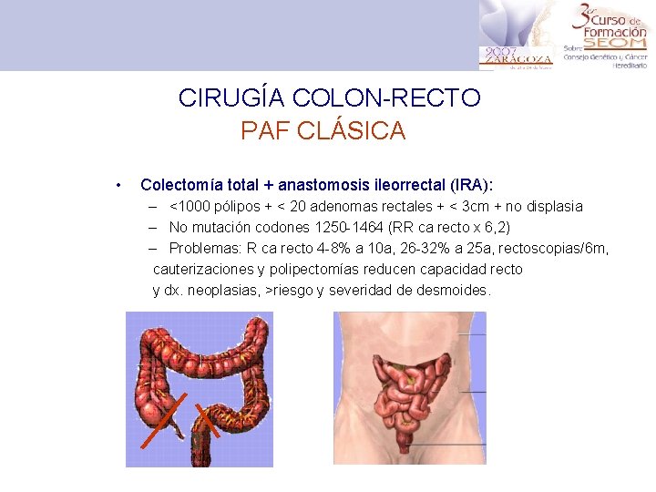 CIRUGÍA COLON-RECTO PAF CLÁSICA • Colectomía total + anastomosis ileorrectal (IRA): – <1000 pólipos