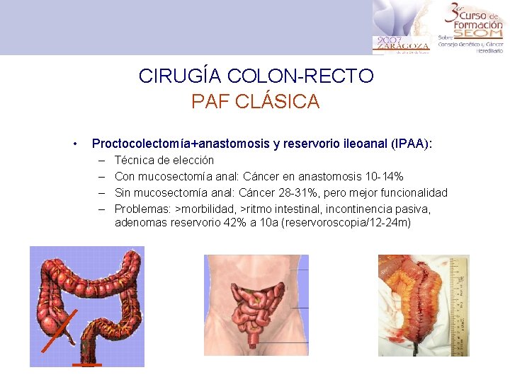 CIRUGÍA COLON-RECTO PAF CLÁSICA • Proctocolectomía+anastomosis y reservorio ileoanal (IPAA): – – Técnica de