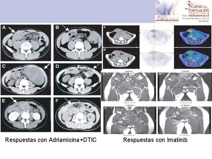 Respuestas con Adriamicina+DTIC Respuestas con Imatinib 