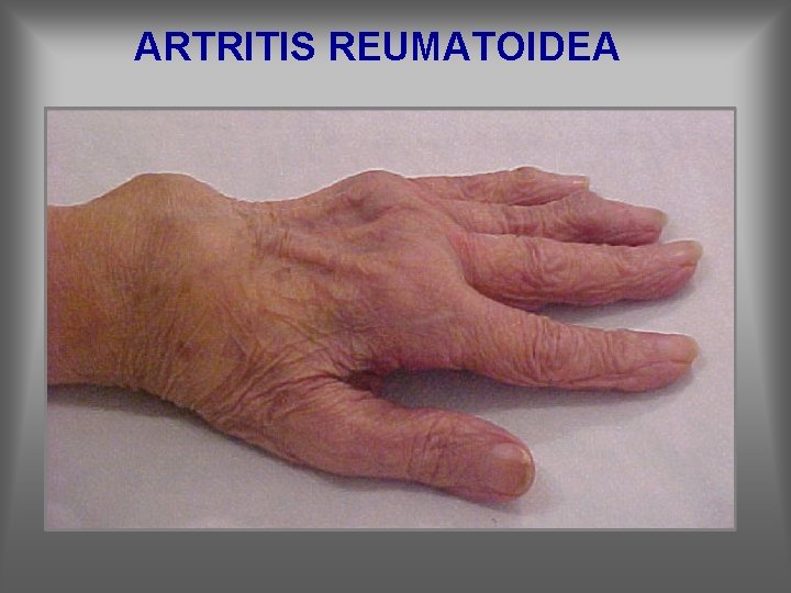ARTRITIS REUMATOIDEA 