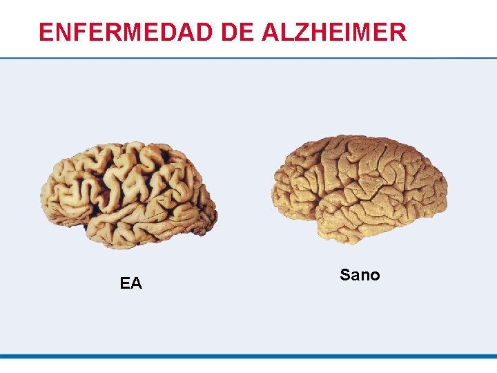 ENFERMEDAD DE ALZHEIMER EA Sano 