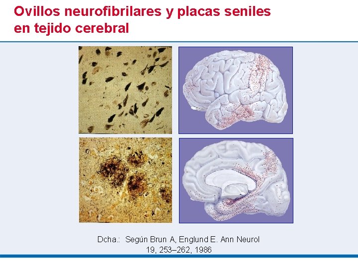Ovillos neurofibrilares y placas seniles en tejido cerebral Dcha. : Según Brun A, Englund