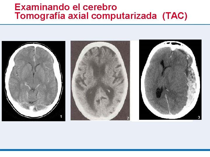 Examinando el cerebro Tomografía axial computarizada (TAC) 1 2 3 3 