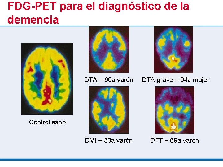 FDG-PET para el diagnóstico de la demencia DTA – 60 a varón DTA grave