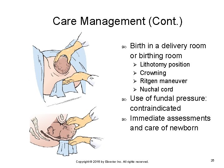 Care Management (Cont. ) Birth in a delivery room or birthing room Lithotomy position