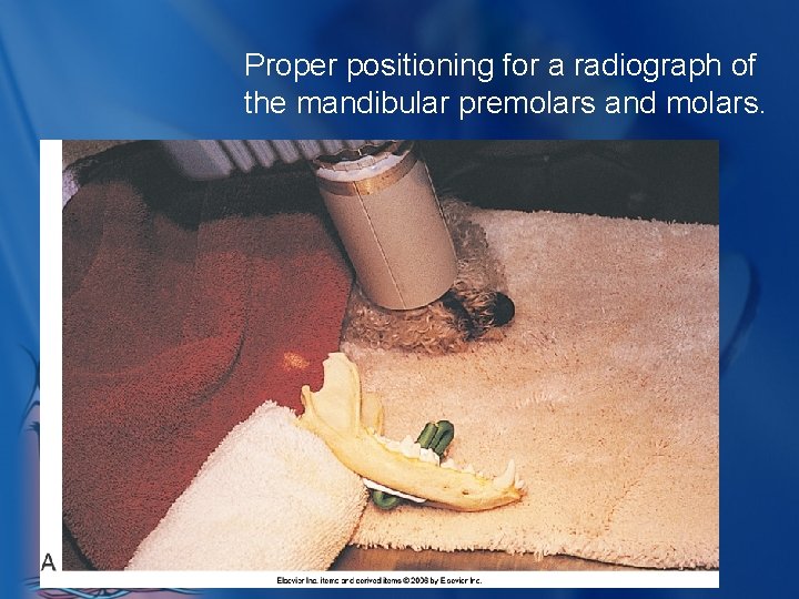 Proper positioning for a radiograph of the mandibular premolars and molars. 