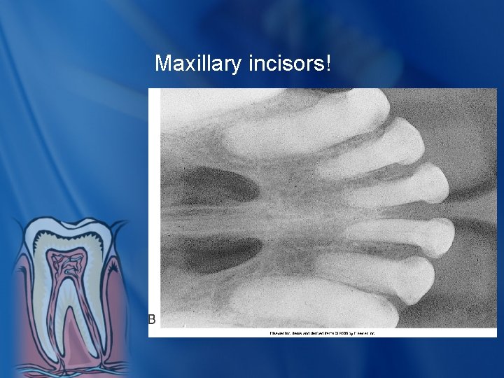 Maxillary incisors! 