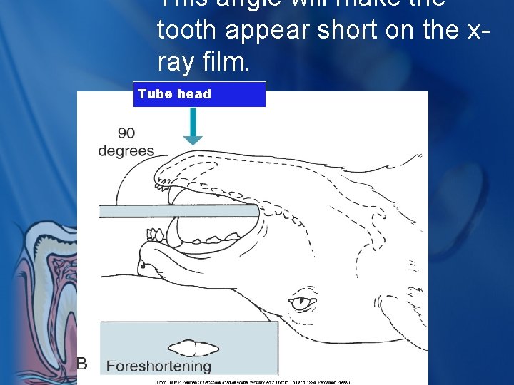 This angle will make the tooth appear short on the xray film. Tube head