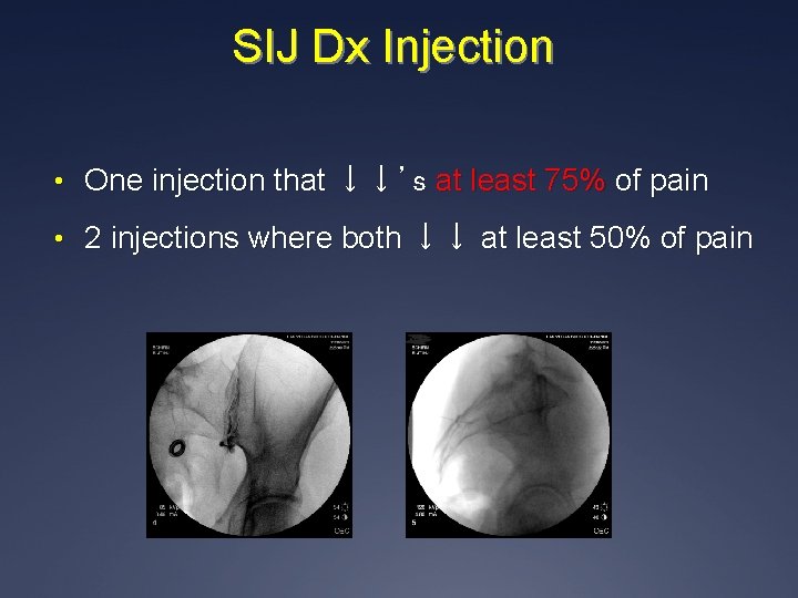 SIJ Dx Injection • One injection that ↓↓’s at least 75% of pain •
