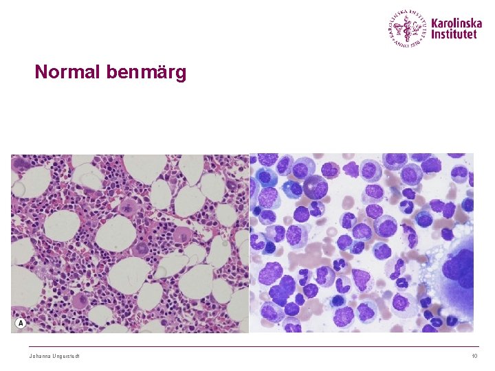 Normal benmärg Johanna Ungerstedt 10 
