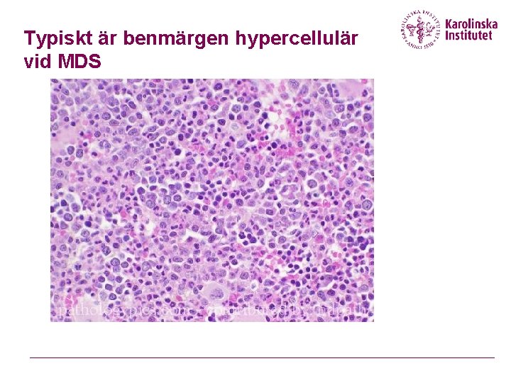 Typiskt är benmärgen hypercellulär vid MDS 