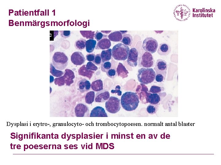 Patientfall 1 Benmärgsmorfologi Dysplasi i erytro-, granulocyto- och trombocytopoesen. normalt antal blaster Signifikanta dysplasier Patientfall 1 Benmärgsmorfologi Dysplasi i erytro-, granulocyto- och trombocytopoesen. normalt antal blaster Signifikanta dysplasier