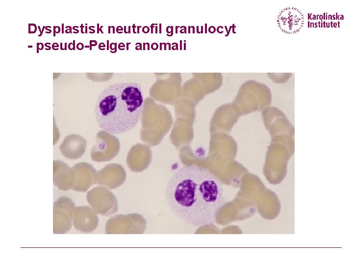 Dysplastisk neutrofil granulocyt - pseudo-Pelger anomali Dysplastisk neutrofil granulocyt - pseudo-Pelger anomali