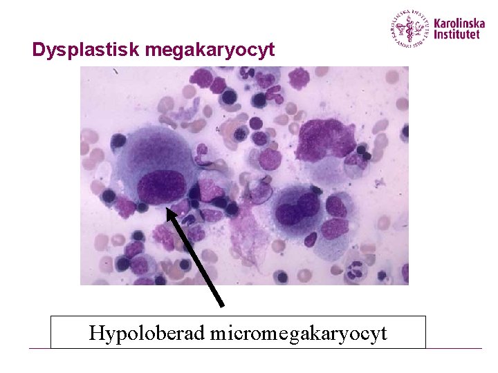 Dysplastisk megakaryocyt Hypoloberad micromegakaryocyt 