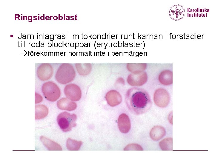 Ringsideroblast § Järn inlagras i mitokondrier runt kärnan i förstadier till röda blodkroppar (erytroblaster)