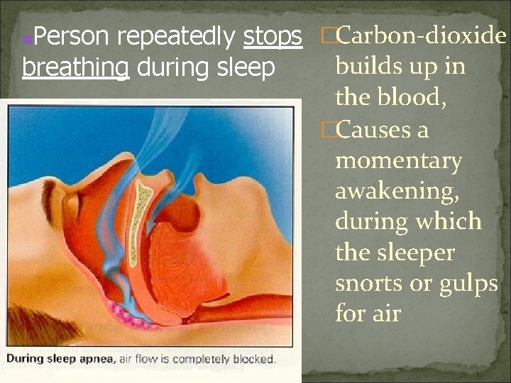 Person repeatedly stops �Carbon-dioxide builds up in breathing during sleep the blood, �Causes a