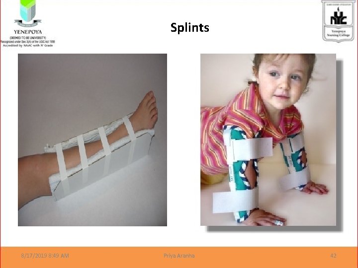 Splints 8/17/2019 8: 49 AM Priya Aranha 42 