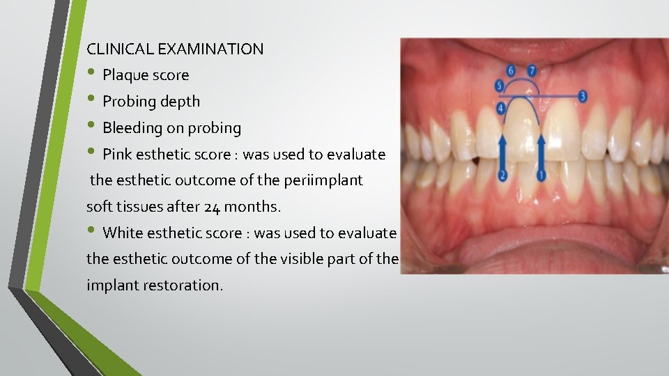 CLINICAL EXAMINATION • Plaque score • Probing depth • Bleeding on probing • Pink