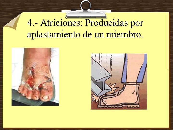 4. - Atriciones: Producidas por aplastamiento de un miembro. 