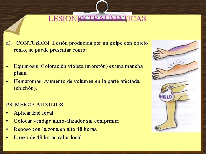 LESIONES TRAUMATICAS a). _ CONTUSIÓN: Lesión producida por un golpe con objeto romo, se