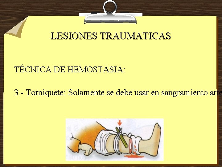 LESIONES TRAUMATICAS TÉCNICA DE HEMOSTASIA: 3. - Torniquete: Solamente se debe usar en sangramiento