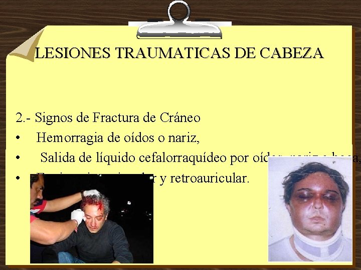 LESIONES TRAUMATICAS DE CABEZA 2. - Signos de Fractura de Cráneo • Hemorragia de