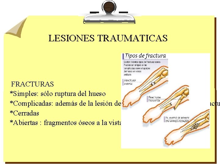 LESIONES TRAUMATICAS FRACTURAS *Simples: sólo ruptura del hueso *Complicadas: además de la lesión del