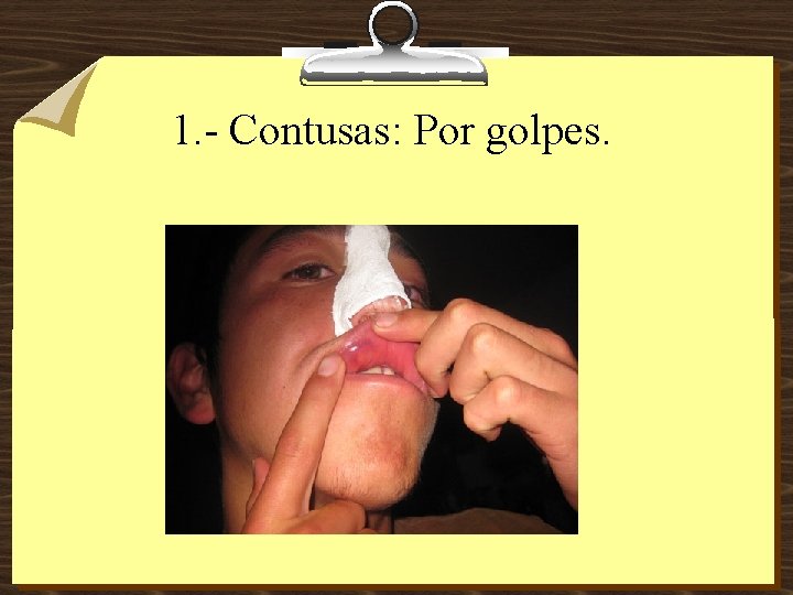 1. - Contusas: Por golpes. 