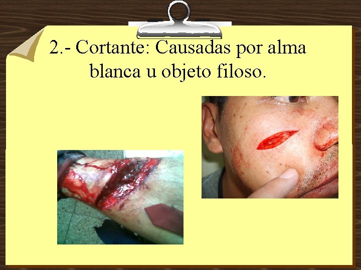 2. - Cortante: Causadas por alma blanca u objeto filoso. 