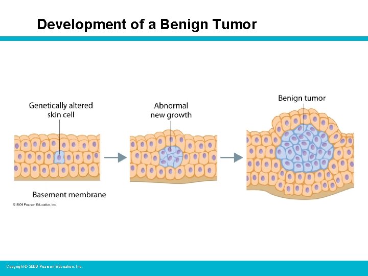 Development of a Benign Tumor Copyright © 2009 Pearson Education, Inc. 