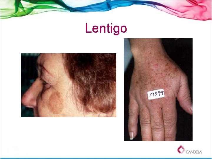 Lentigo 