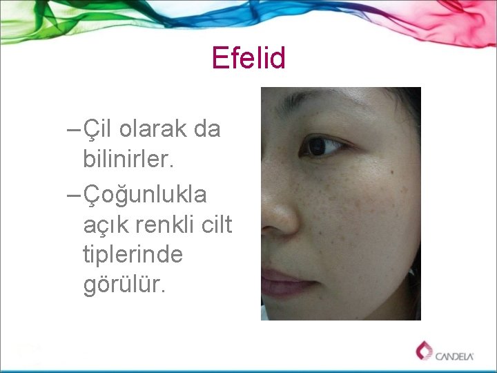 Efelid – Çil olarak da bilinirler. – Çoğunlukla açık renkli cilt tiplerinde görülür. 