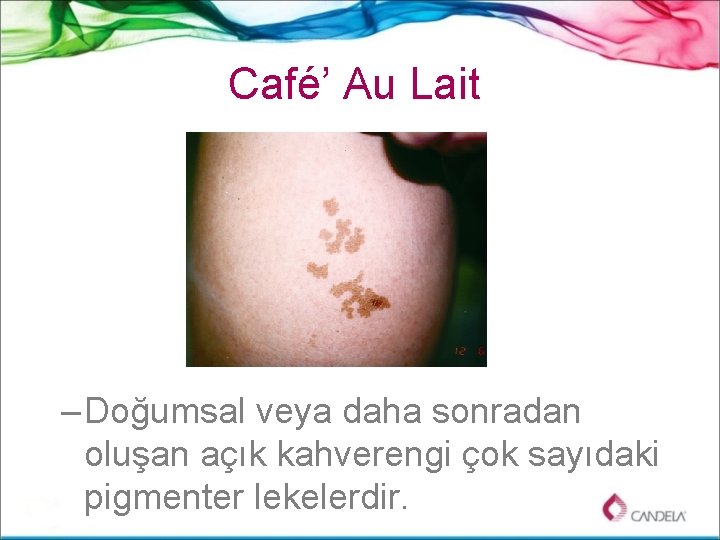 Café’ Au Lait – Doğumsal veya daha sonradan oluşan açık kahverengi çok sayıdaki pigmenter