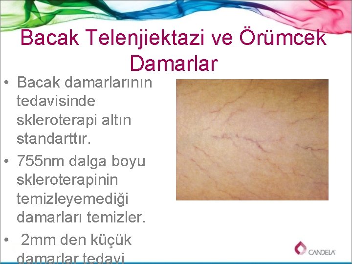 Bacak Telenjiektazi ve Örümcek Damarlar • Bacak damarlarının tedavisinde skleroterapi altın standarttır. • 755