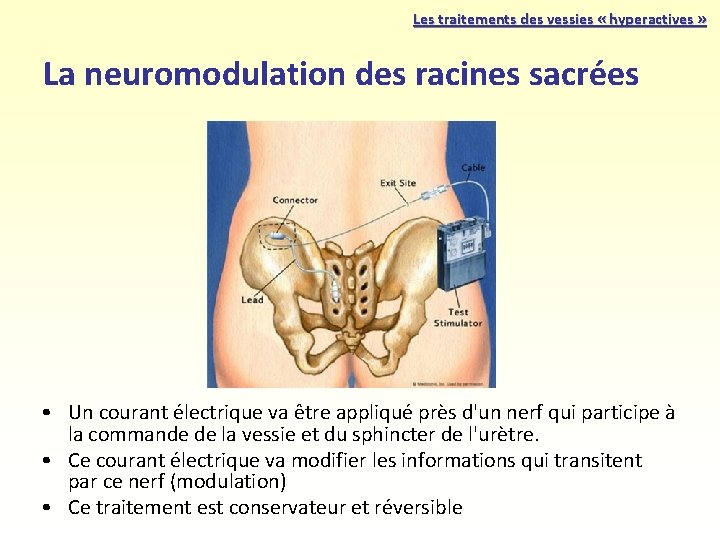 Les traitements des vessies « hyperactives » La neuromodulation des racines sacrées • Un Les traitements des vessies « hyperactives » La neuromodulation des racines sacrées • Un