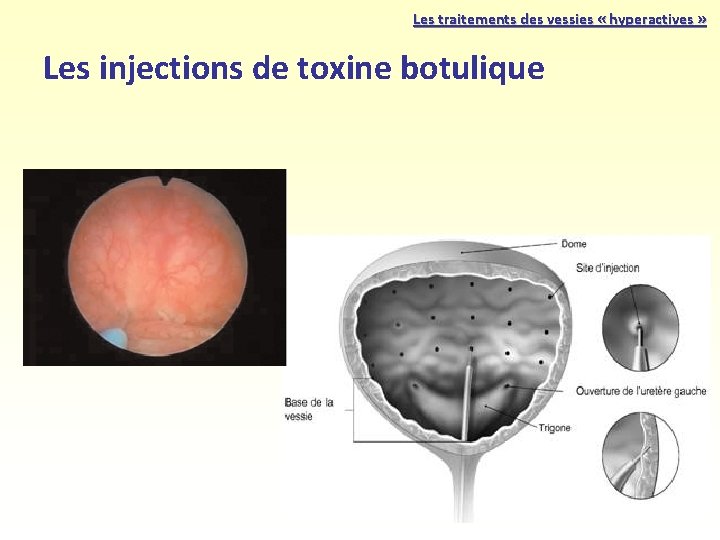 Les traitements des vessies « hyperactives » Les injections de toxine botulique 