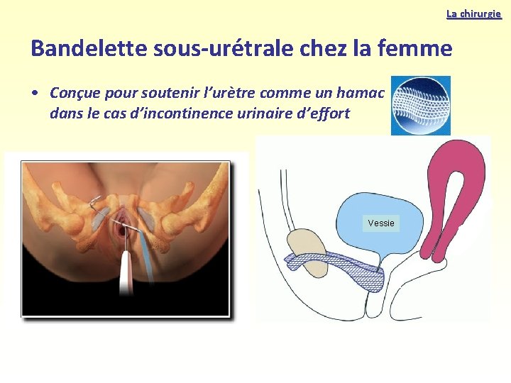 La chirurgie Bandelette sous-urétrale chez la femme • Conçue pour soutenir l’urètre comme un