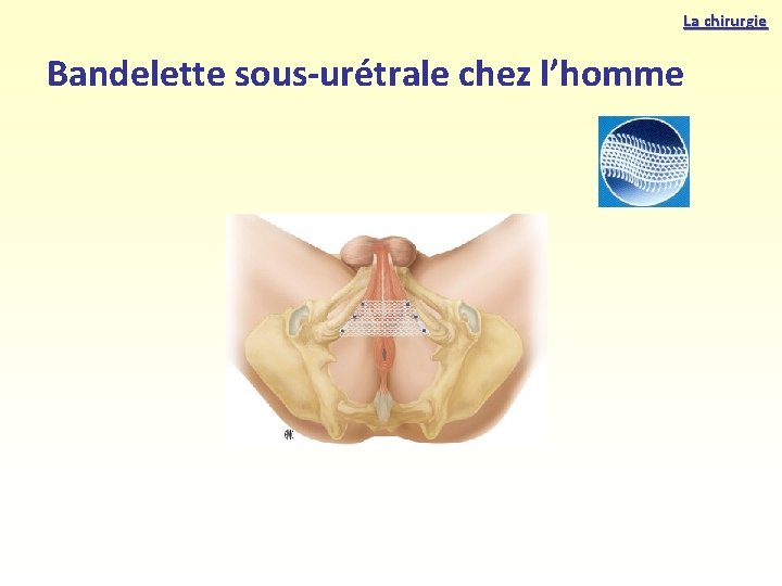 La chirurgie Bandelette sous-urétrale chez l’homme 