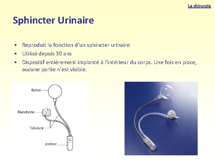 La chirurgie Sphincter Urinaire • Reproduit la fonction d’un sphincter urinaire • Utilisé depuis